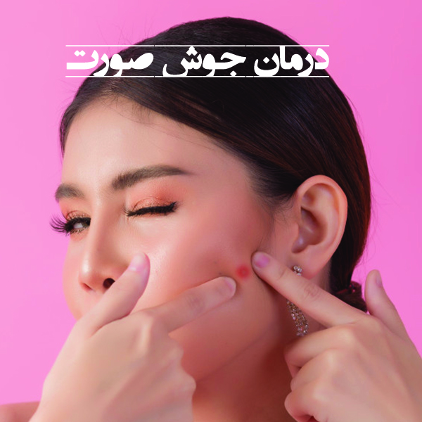 علت جوش صورت چیست؟, درمان آکنه, درمان جوش چانه